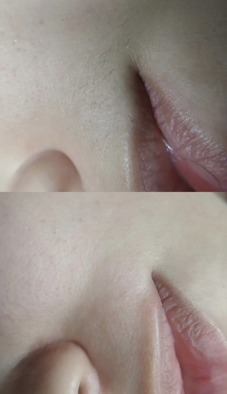 Antes e depois da remoção dos pelos e pele lisa